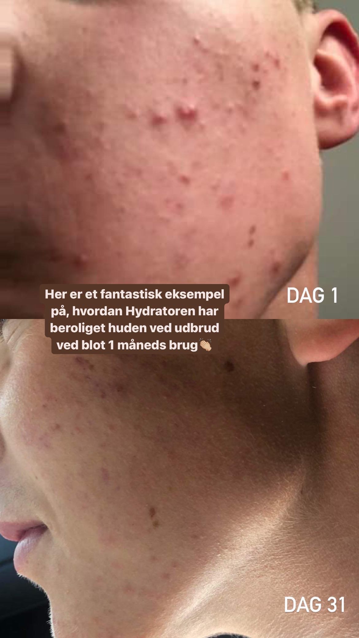 Før og efter billede ved brug af serum hydrator